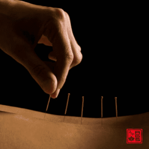 Acupuntura en DM