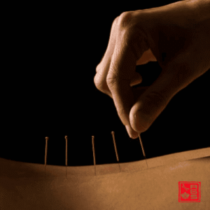 Acupuntura