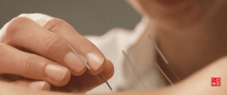 Tratamiento de Acupuntura